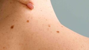dermatosi papulosa nigra