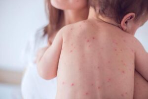 morbillo alina di ronza
