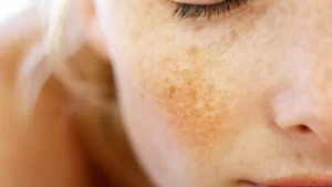 melasma in gravidanza