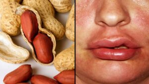 Allergia frutta a guscio dott alina di ronza