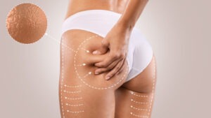 La cellulite dott alina di ronza