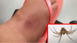 Ragno violino dott alina di ronza