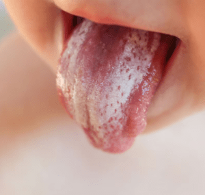 Candida Orale dott.ssa Alina di Ronza
